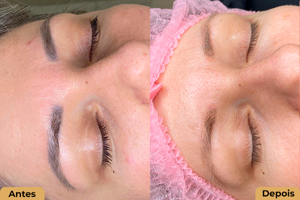 Plenure-antes e depois